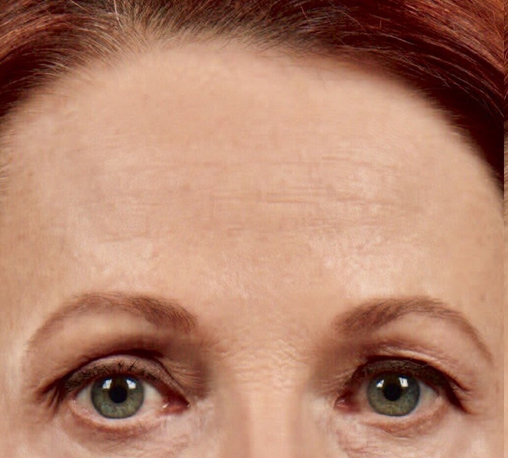 Alın Botox Fiyatı Alın Botox Fiyatı