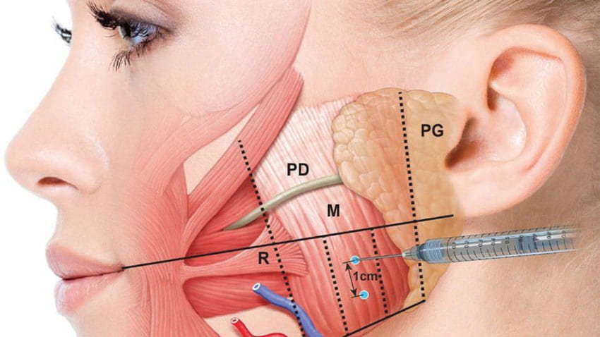 Bruksizm Botox Fiyatı Bruksizm Botox Fiyatı